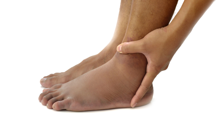 علائم آمبولی پا یا لخته خون در پا چیست؟