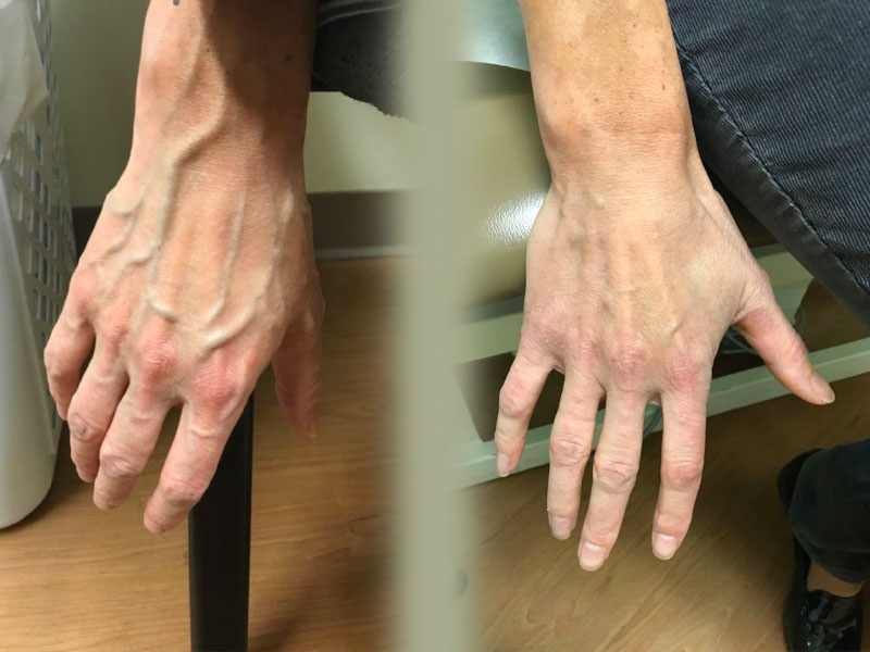قبل و بعد درمان واریس دست