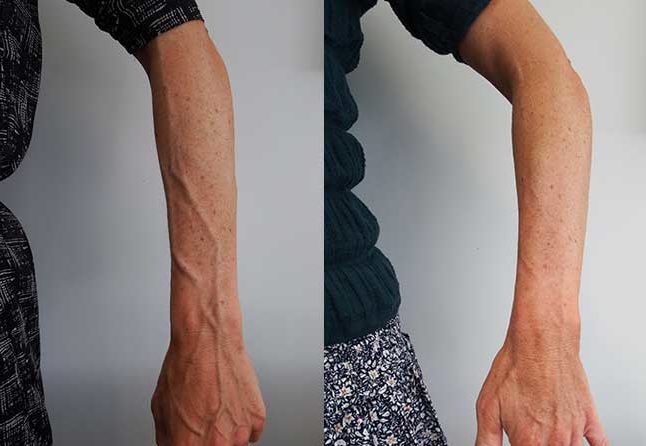عکس واریس دست قبل و بعد از درمان