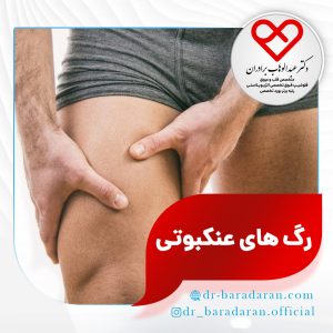 رگ‌های آبی و بنفش روی ران پا (رگ‌های عنکبوتی)