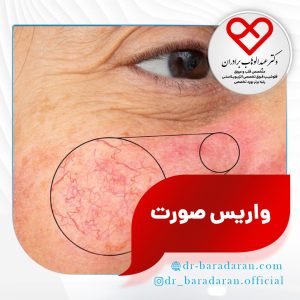 درمان واریس صورت یا رگ های عنکبوتی با لیزر و اسکلروتراپی